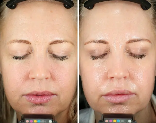 50% OFF CO2 Laser Treatment - Northvilla Beauty Spa