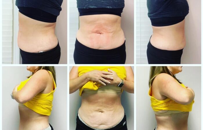 Is Emsculpt Neo Worth It: Who Makes the Best Candidate - Northvilla Beauty Spa