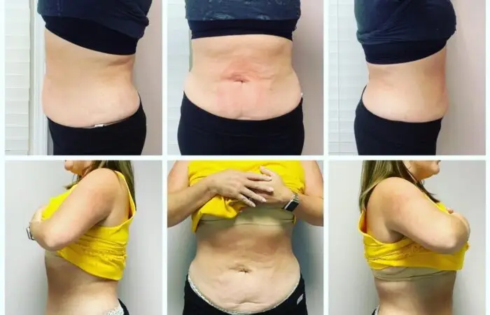 Is Emsculpt Neo Worth It: Who Makes the Best Candidate - Northvilla Beauty Spa