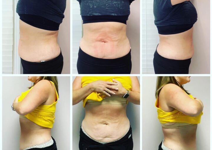 Is Emsculpt Neo Worth It: Who Makes the Best Candidate - Northvilla Beauty Spa