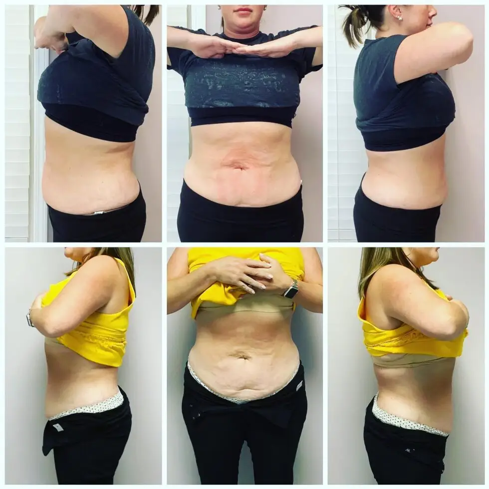 Is Emsculpt Neo Worth It: Who Makes the Best Candidate - Northvilla Beauty Spa