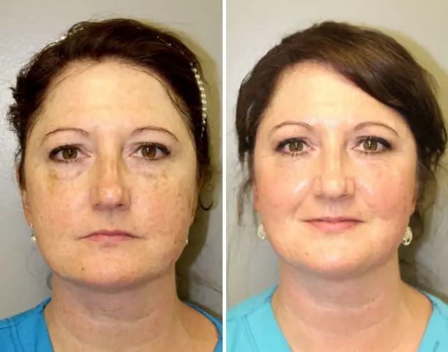 50% OFF CO2 Laser Treatment - Northvilla Beauty Spa