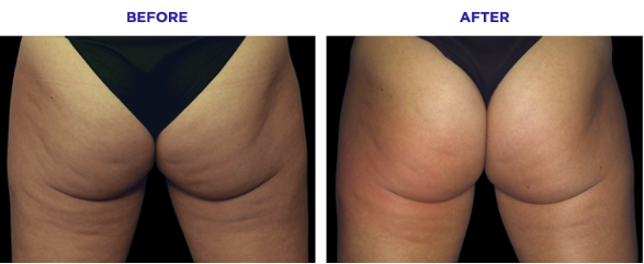 Emtone Before and After: What to Expect Session by Session - Northvilla Beauty Spa