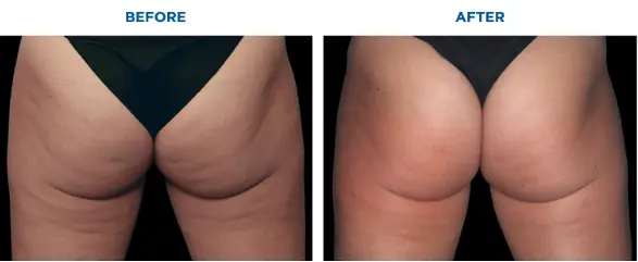 Emtone Before and After: What to Expect Session by Session - Northvilla Beauty Spa