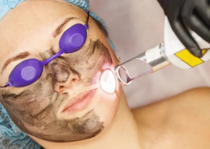 Helix CO2 Laser  - Northvilla Beauty Spa
