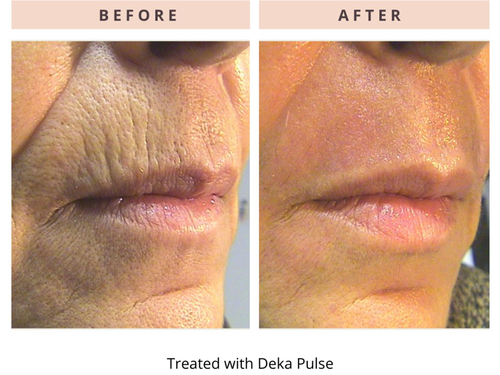 Helix CO2 Laser  - Northvilla Beauty Spa