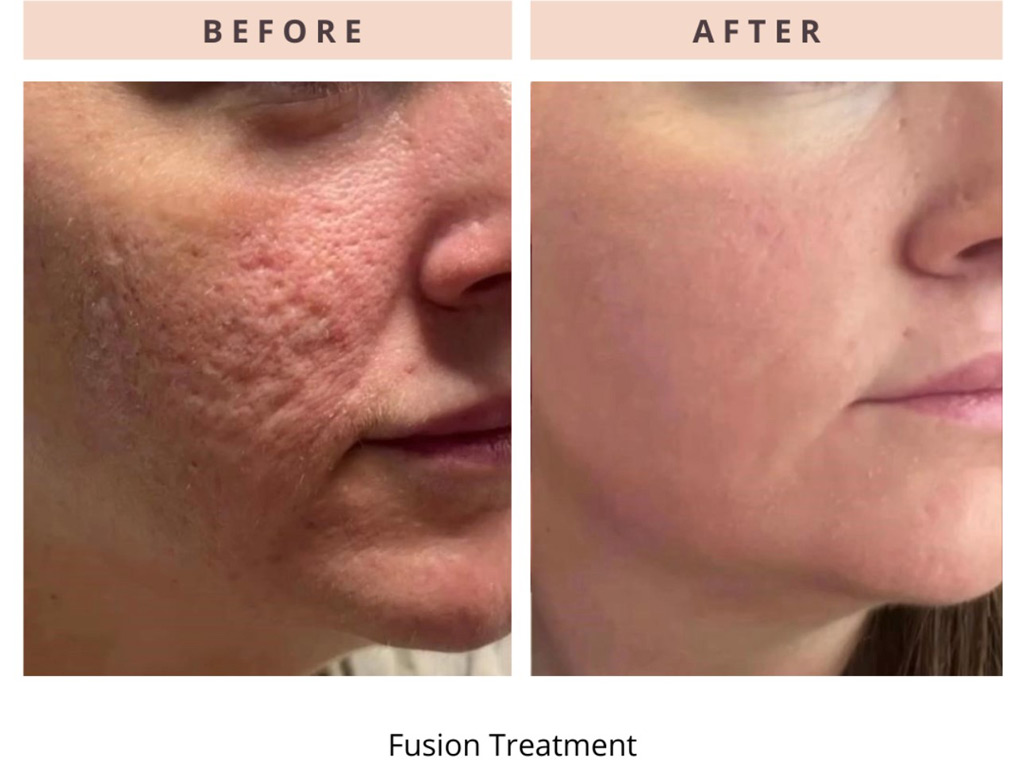 Helix CO2 Laser  - Northvilla Beauty Spa