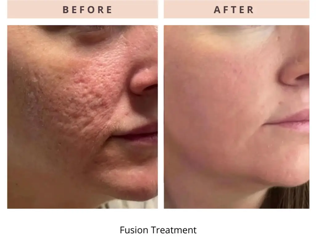 Helix CO2 Laser  - Northvilla Beauty Spa