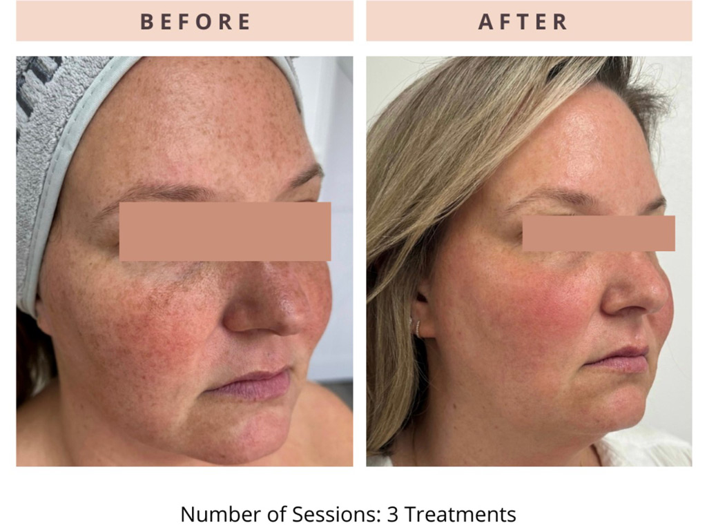 Helix CO2 Laser  - Northvilla Beauty Spa