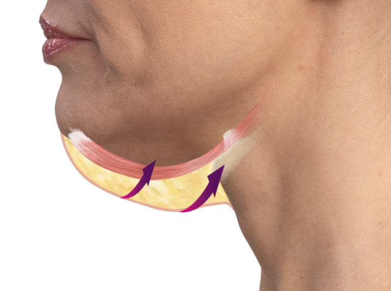 Emface & Submentum - Northvilla Beauty Spa