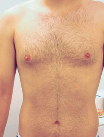 Laser Hair Removal - Northvilla Beauty Spa