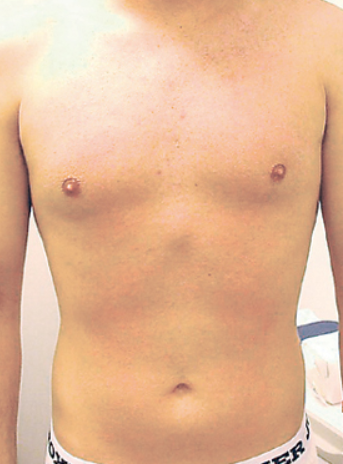 Laser Hair Removal - Northvilla Beauty Spa