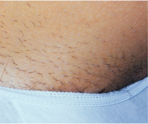 Laser Hair Removal - Northvilla Beauty Spa