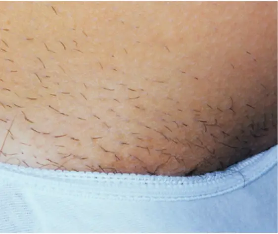 Laser Hair Removal - Northvilla Beauty Spa