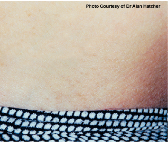 Laser Hair Removal - Northvilla Beauty Spa