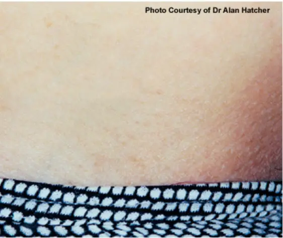 Laser Hair Removal - Northvilla Beauty Spa