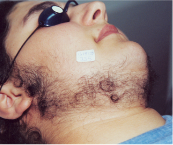 Laser Hair Removal - Northvilla Beauty Spa