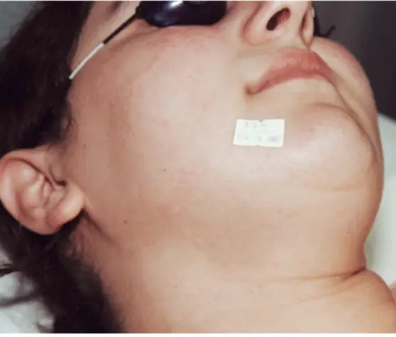 Laser Hair Removal - Northvilla Beauty Spa