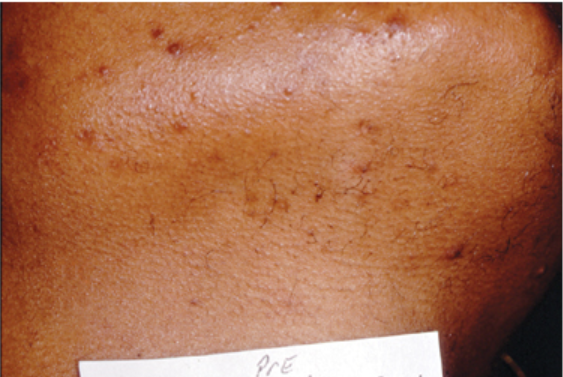 Laser Hair Removal - Northvilla Beauty Spa