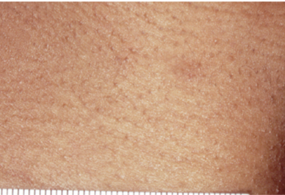 Laser Hair Removal - Northvilla Beauty Spa