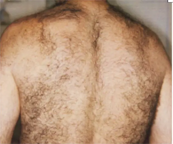 Laser Hair Removal - Northvilla Beauty Spa