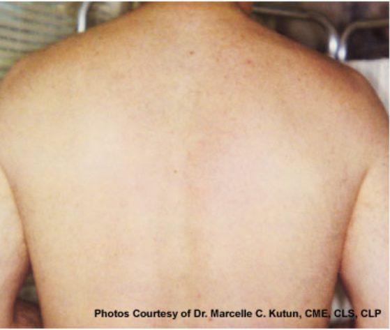 Laser Hair Removal - Northvilla Beauty Spa