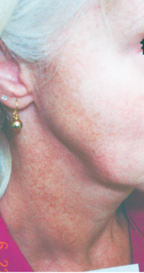 Laser Hair Removal - Northvilla Beauty Spa