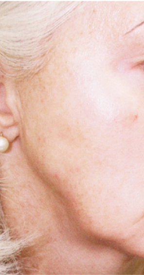 Laser Hair Removal - Northvilla Beauty Spa