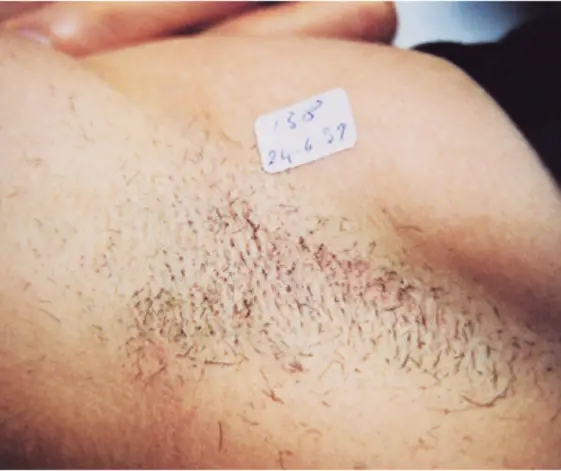 Laser Hair Removal - Northvilla Beauty Spa