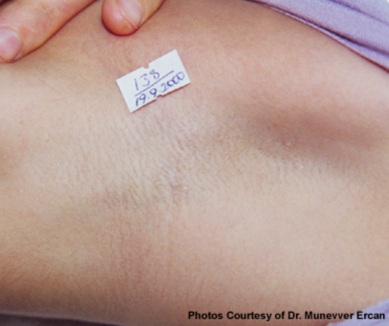 Laser Hair Removal - Northvilla Beauty Spa