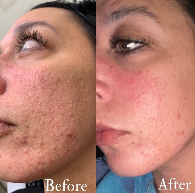 VI-Peel-010 - Northvilla Beauty Spa