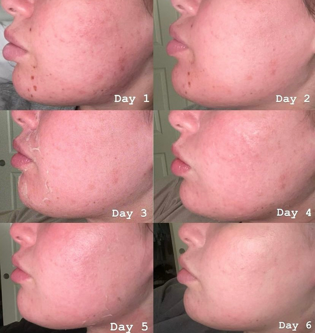 VI-Peel-011 - Northvilla Beauty Spa