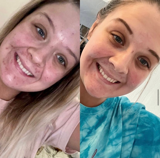 VI-Peel-012 - Northvilla Beauty Spa