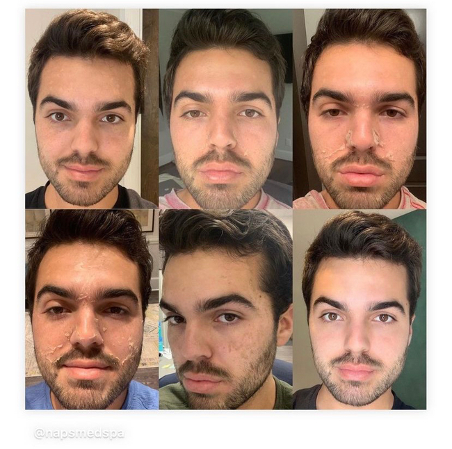 VI-Peel-013 - Northvilla Beauty Spa