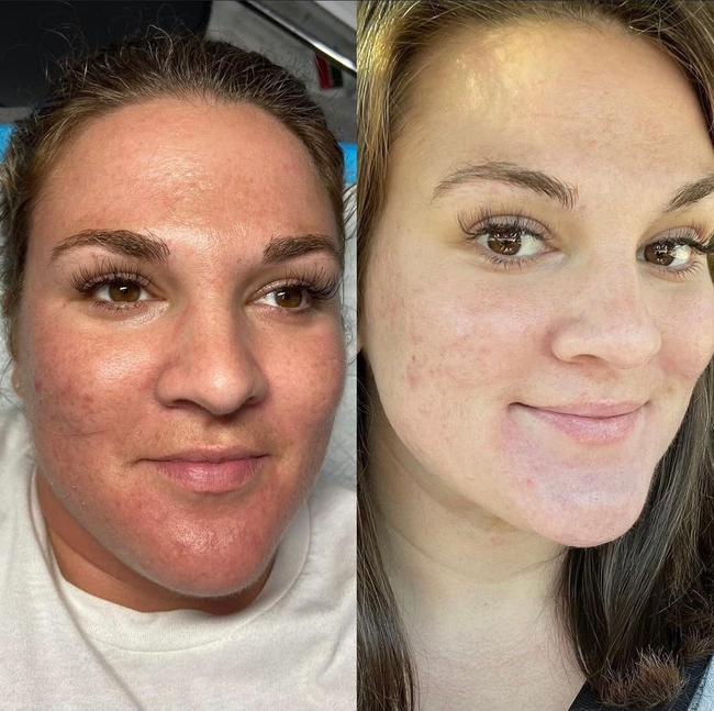 VI-Peel-015 - Northvilla Beauty Spa