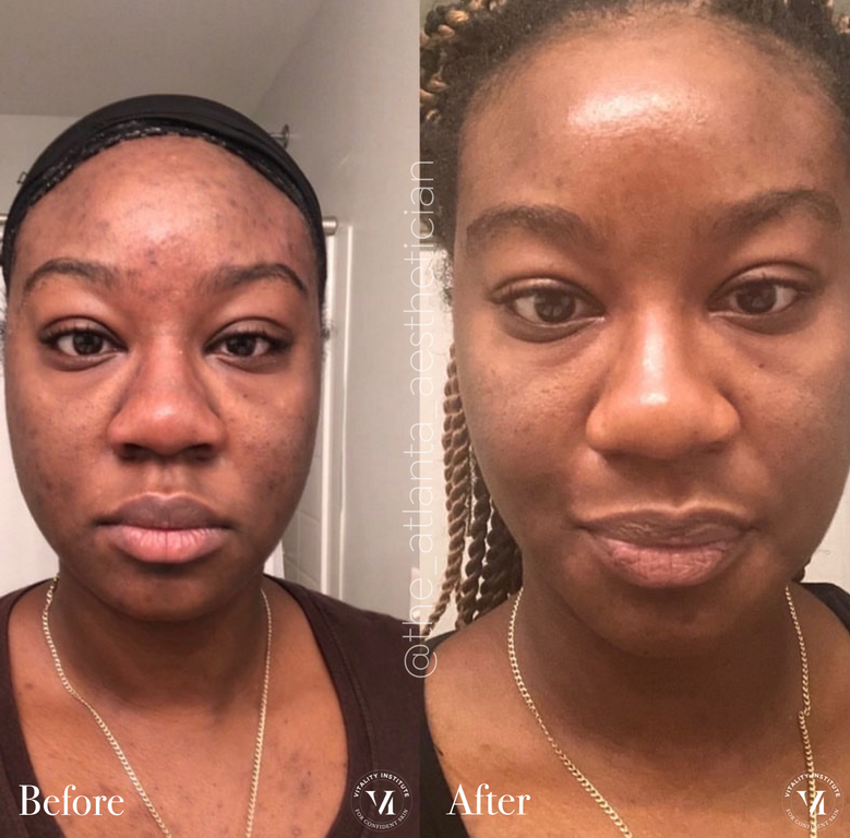 VI-Peel-016 - Northvilla Beauty Spa