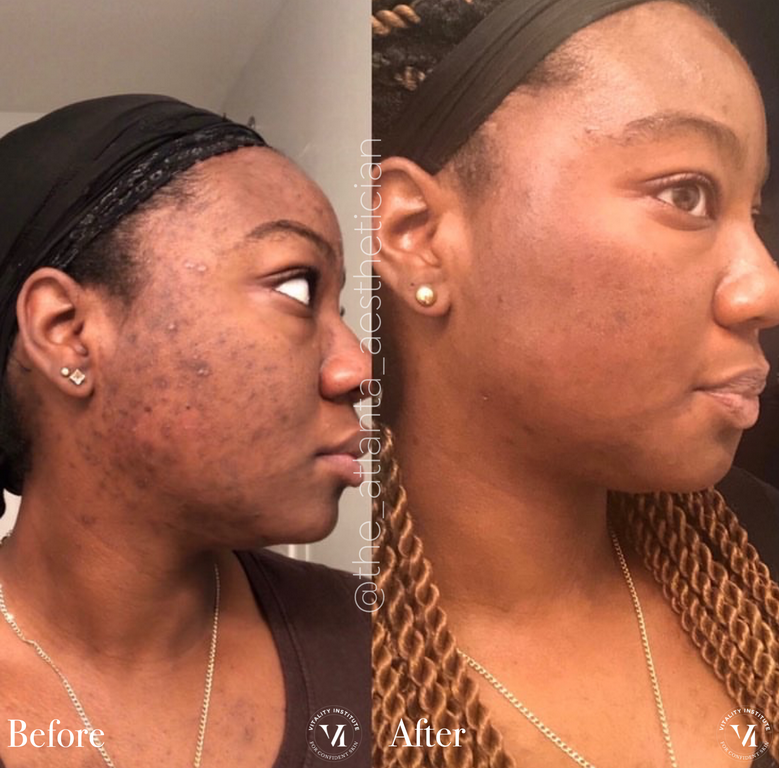 VI-Peel-018 - Northvilla Beauty Spa