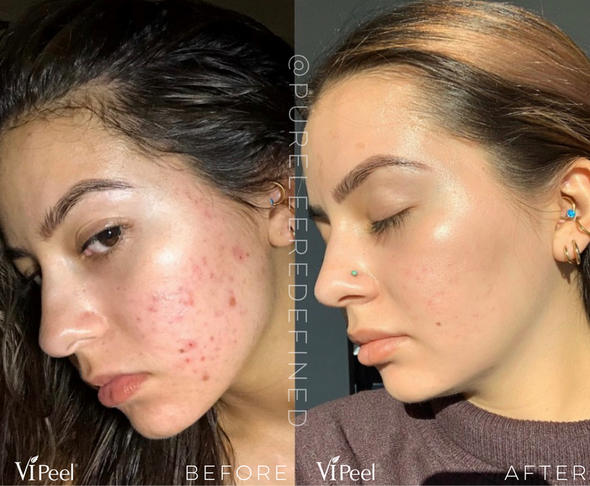 VI-Peel-020 - Northvilla Beauty Spa