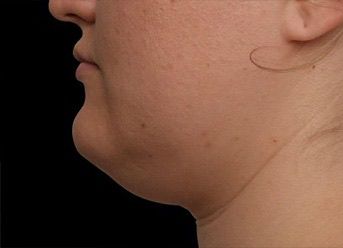 Emface & Submentum - Northvilla Beauty Spa