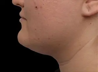 Emface & Submentum - Northvilla Beauty Spa