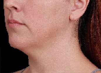 Emface & Submentum - Northvilla Beauty Spa