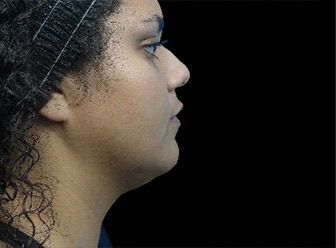 Emface & Submentum - Northvilla Beauty Spa