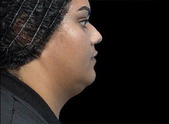 Emface & Submentum - Northvilla Beauty Spa