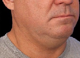 Emface & Submentum - Northvilla Beauty Spa