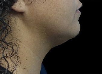 Emface & Submentum - Northvilla Beauty Spa