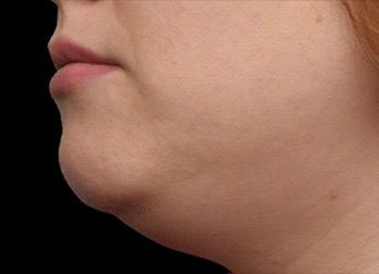 Emface & Submentum - Northvilla Beauty Spa