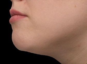 Emface & Submentum - Northvilla Beauty Spa