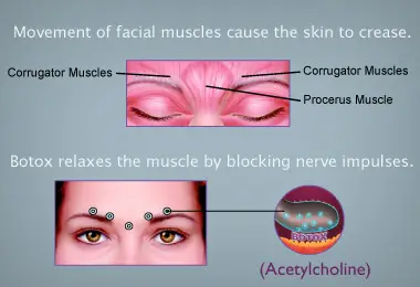 Botox - Northvilla Beauty Spa