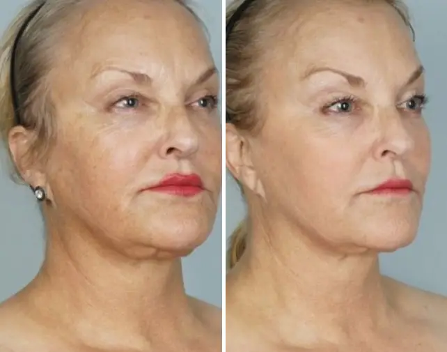 50% OFF CO2 Laser Treatment - Northvilla Beauty Spa