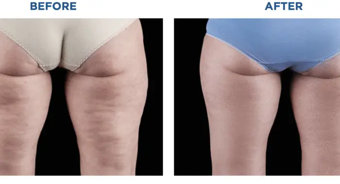 Choosing Between Emtone vs Emsculpt Neo: Which Is Right for You - Northvilla Beauty Spa